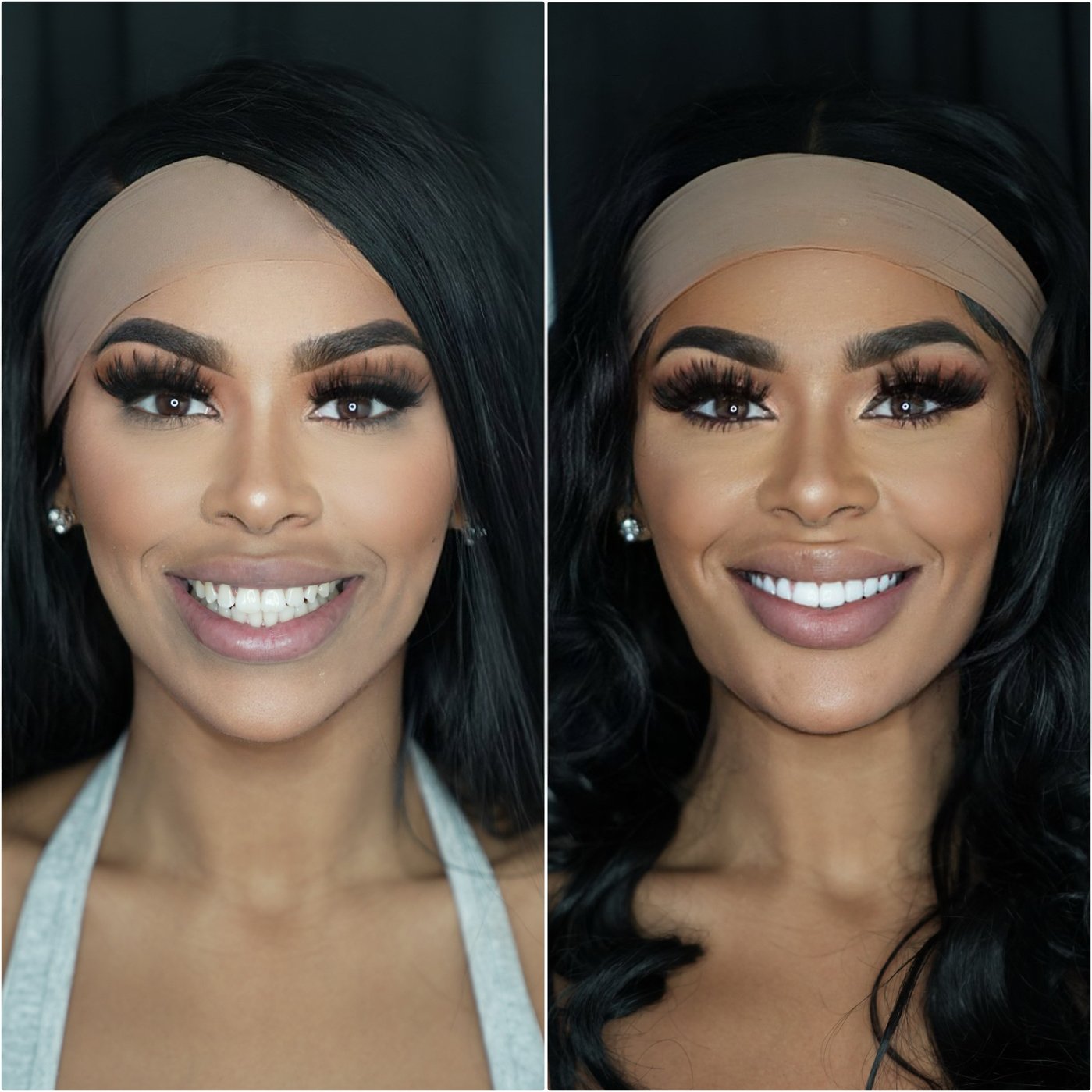 porcelainveneers2